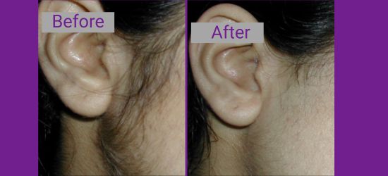 Affordable Laser Hair Removal Treatment in Ravet