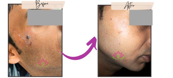 skin clinic for mole removal in chinchwad