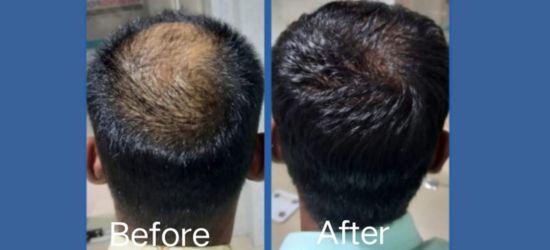 Hair PRP Treatment for Hair growth